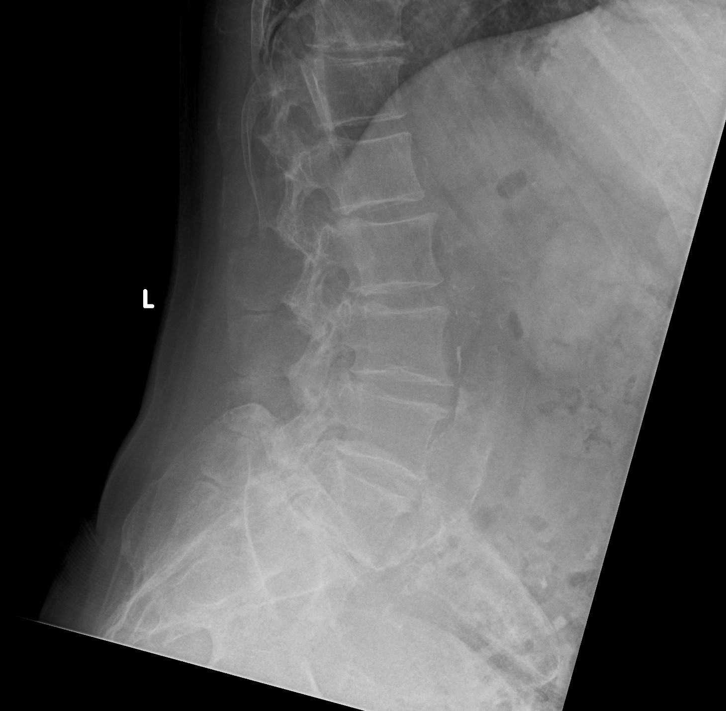 multiple-myeloma-full-skeletal-survey-image-radiopaedia