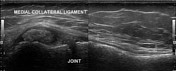 Ultrasound of the knee | Radiology Reference Article | Radiopaedia.org