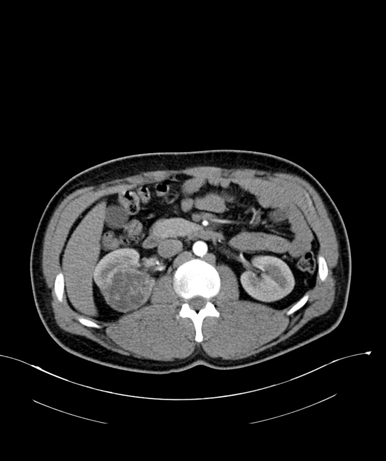 Multilocular cystic renal neoplasm of low malignant potential | Image ...