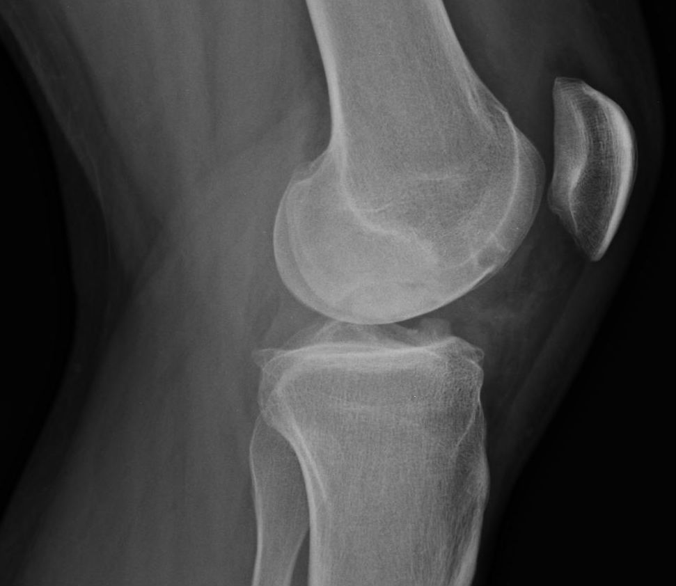 Перелом надколенника. Остеохондропатия надколенника болезнь Ларсена. Остеохондропатия надколенника (болезнь Синдинга-Ларсена-Иогансона). Перелом надколенника рентген. Вывих надколенника рентген.