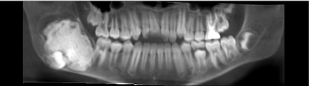 Ameloblastic Fibroodontoma Of The Mandible | Radiology Case ...