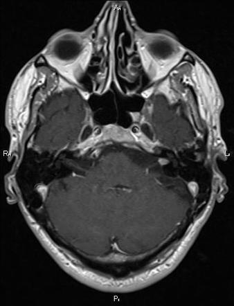 Koos grading scale | Radiology Reference Article | Radiopaedia.org