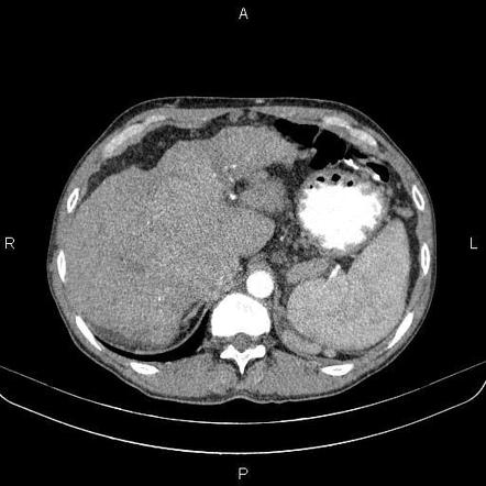 Cirrhosis | Radiology Reference Article | Radiopaedia.org