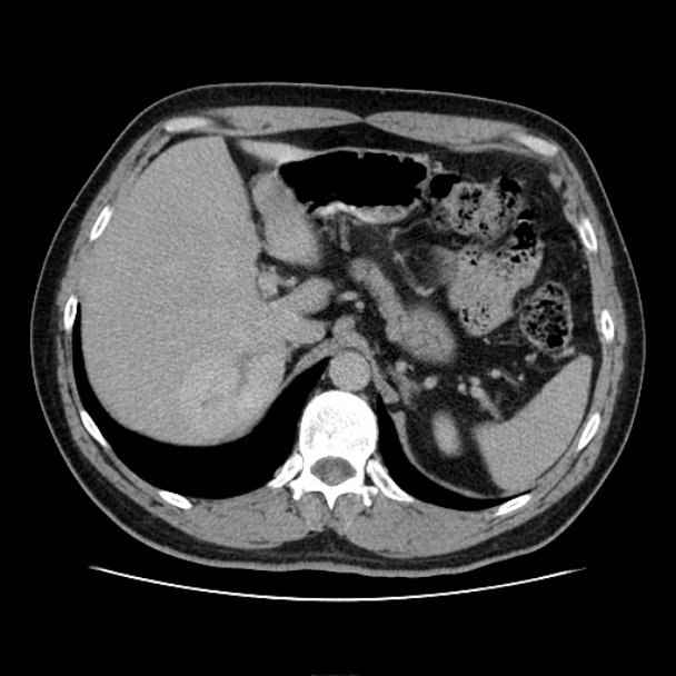 Hepatic hemangiomata | Image | Radiopaedia.org