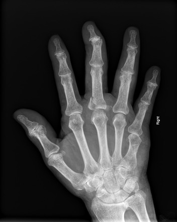 Shortening of the fourth/fifth metacarpals | Radiology Reference ...