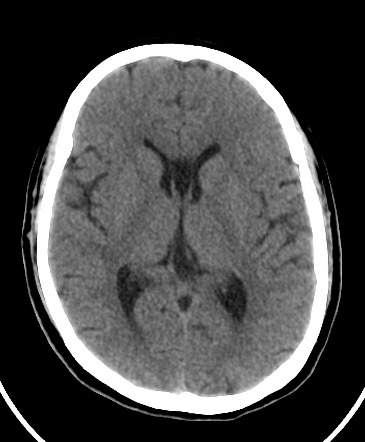 Cavum septum pellucidum and cavum vergae | Radiology Case | Radiopaedia.org