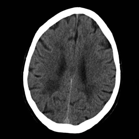 Vascular dementia | Radiology Case | Radiopaedia.org