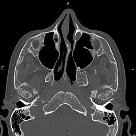 Thalassemia | Image | Radiopaedia.org