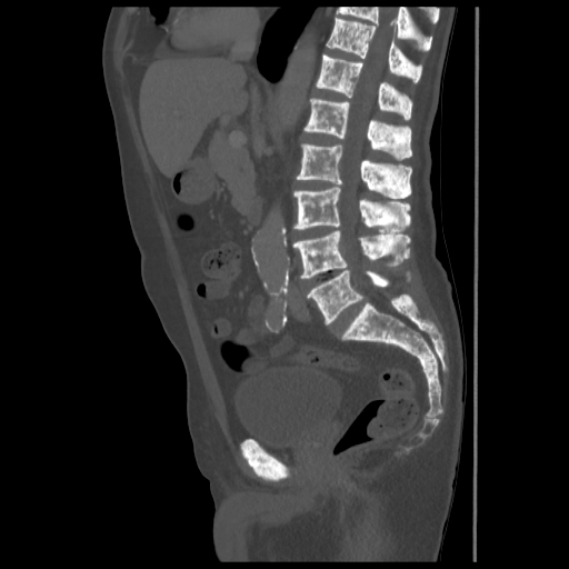 What Is Diffuse Osteoblastic Metastatic Disease