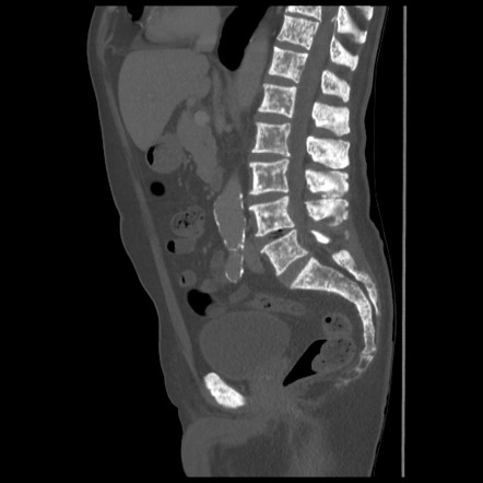 Diffuse osteoblastic metastases - prostate cancer | image | radiopaedia.org