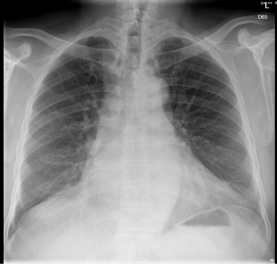 Cardiomegaly with left atrium enlargement | Image | Radiopaedia.org