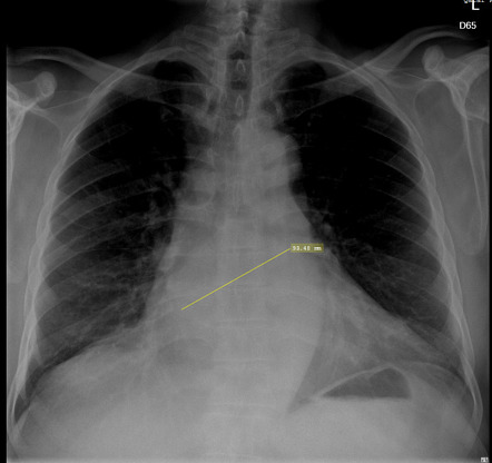 Cardiomegaly With Left Atrium Enlargement 