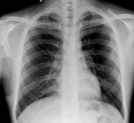 Old rib fracture at posterior shaft Radiology Case Radiopaedia