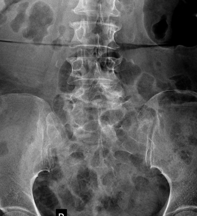 Spondylolisthesis, spondylolysis and spondylosis, with osteoporosis and ...