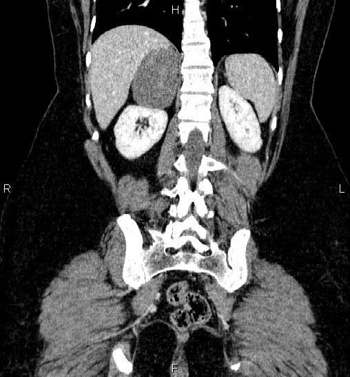 Adrenal cortical carcinoma | Image | Radiopaedia.org