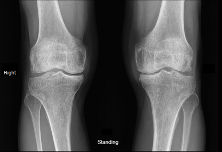 Osteoarthritis of both knee | Radiology Case | Radiopaedia.org