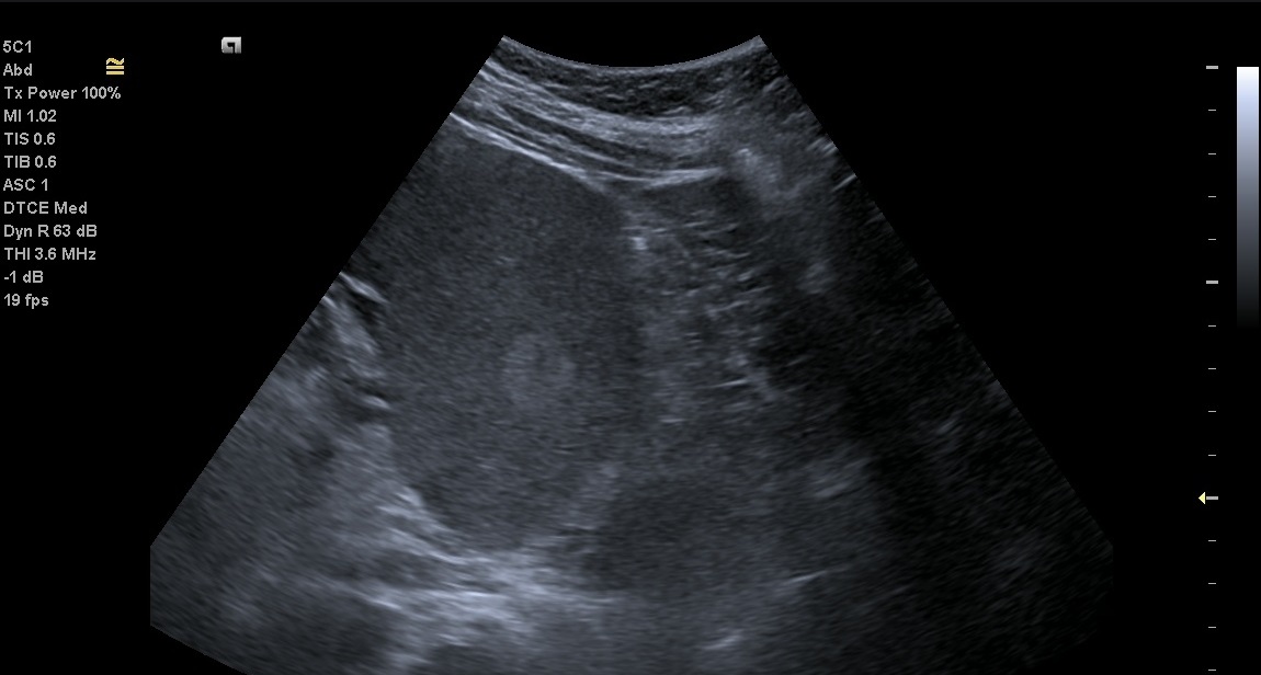 Splenic hemangioma | Image | Radiopaedia.org