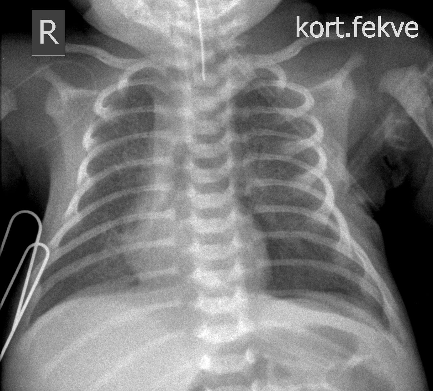 File:Neonatal respiratory distress syndrome, pneumothorax, and PICC ...