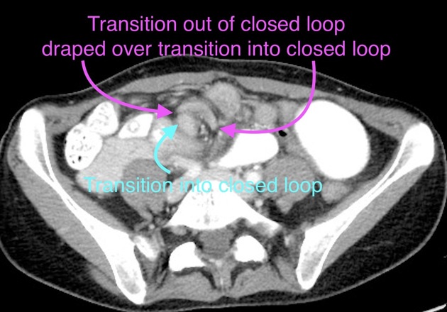 Closed loop obstruction Radiology Reference Article