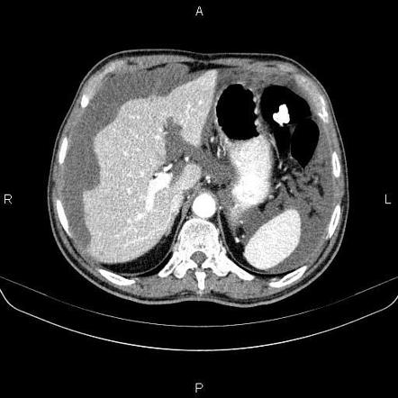 Pseudomyxoma Peritonei Radiology Reference Article Radiopaedia Org