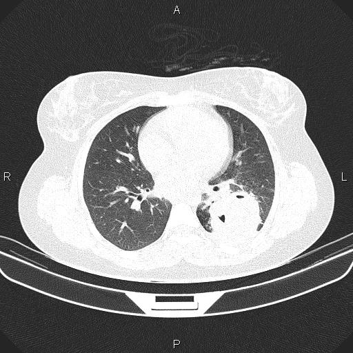 What Are Lung Nodules On Ct Scan Ct Scan Machine 1161