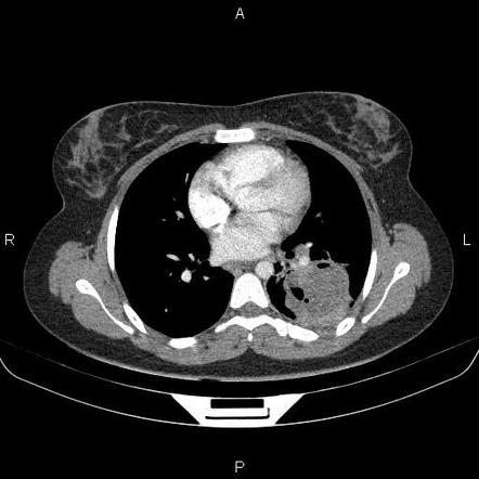 Lung abscess | Radiology Case | Radiopaedia.org