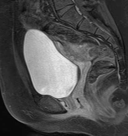 Massive ovarian edema | Image | Radiopaedia.org