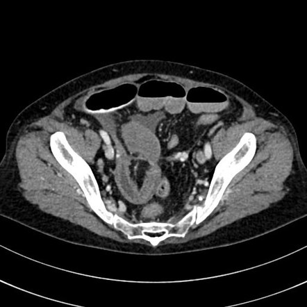 Internal hernia | Radiology Reference Article | Radiopaedia.org