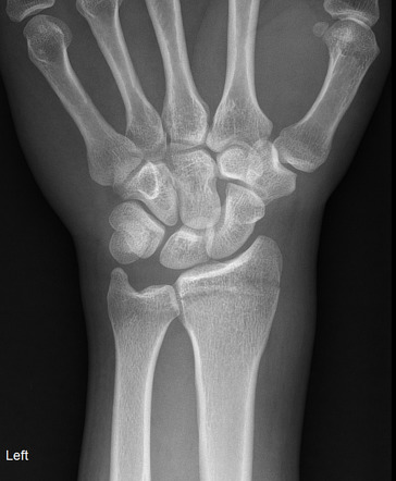 Distal radial fracture | Radiology Case | Radiopaedia.org