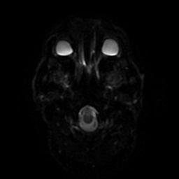 Thalamic Lacunar Infarct 