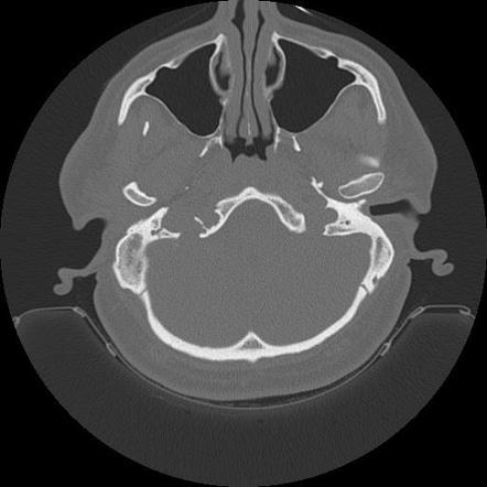 Cholesteatoma | Image | Radiopaedia.org