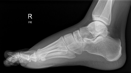 Divergent Lisfranc injury | Image | Radiopaedia.org