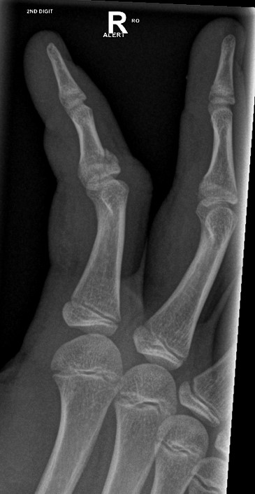 Salter Harris 4 fracture of index finger middle phalanx | Image ...