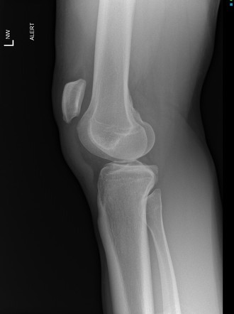 Patellar Tendon Rupture | Radiology Reference Article | Radiopaedia.org