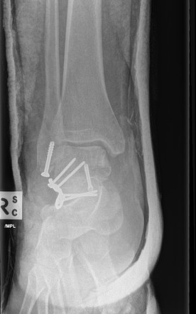 Talar neck fracture - Hawkins type 3 | Image | Radiopaedia.org