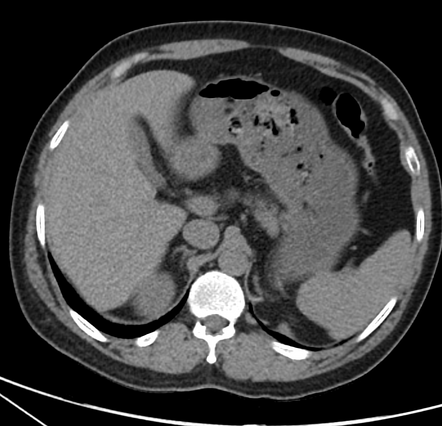 Excessive rectal submucosal and presacral fat due to obesity | Image ...