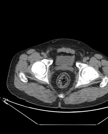 Fat halo sign (inflammatory bowel disease) | Radiology Reference ...