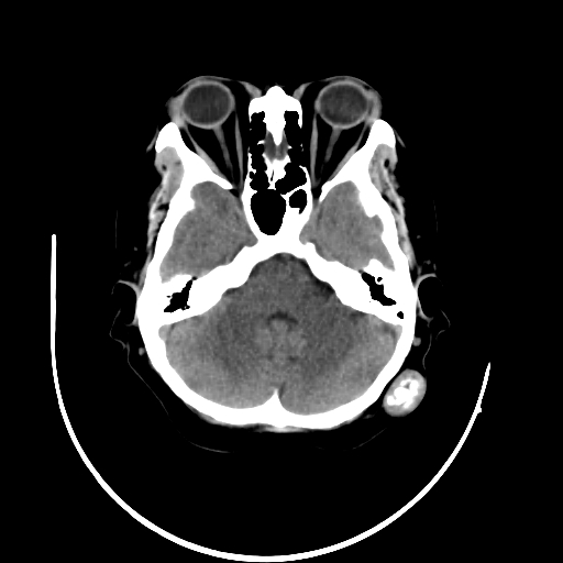 Trichilemmal Cyst Image