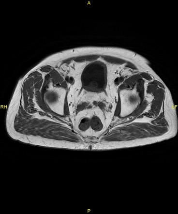 Prostate Cancer - T3b,N1,Mx (bilateral PIRADS 5) | Image | Radiopaedia.org