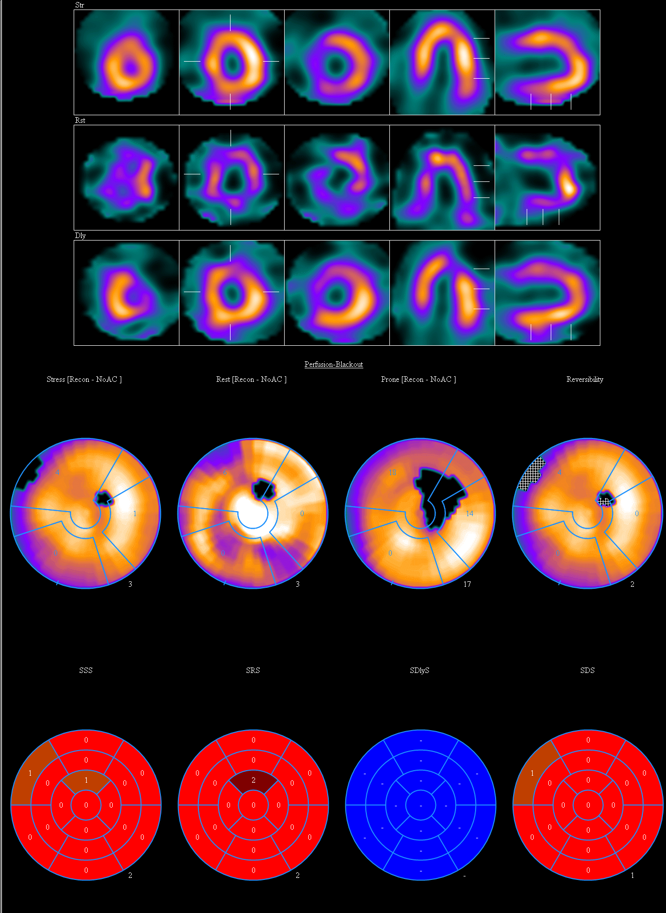 Photon deprivation artifact on nuclear cardiac stress test due to ...