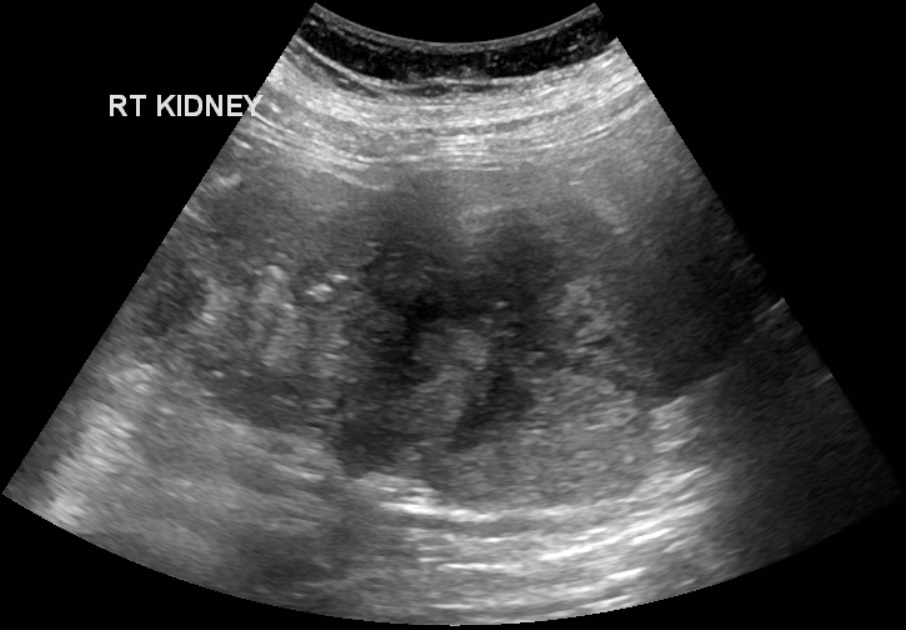 Clear Cell Renal Cell Carcinoma Image Radiopaedia Org