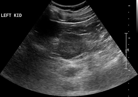 Clear cell renal cell carcinoma | Image | Radiopaedia.org