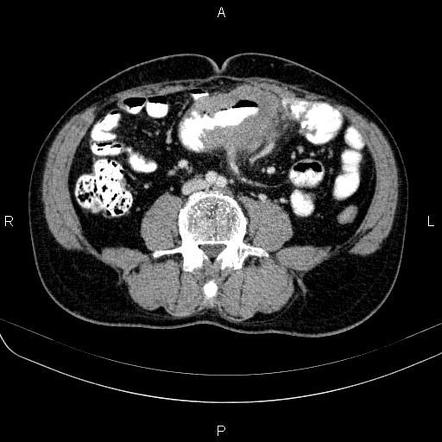 Small bowel lymphoma | Radiology Reference Article | Radiopaedia.org