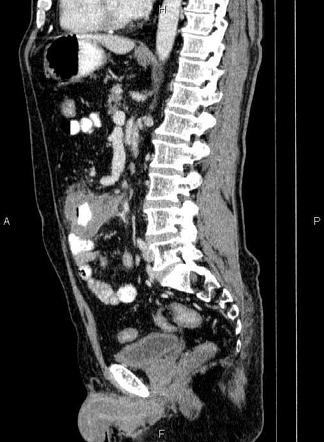 Small bowel lymphoma | Image | Radiopaedia.org