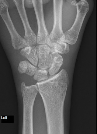 Scaphoid fracture | Radiology Case | Radiopaedia.org