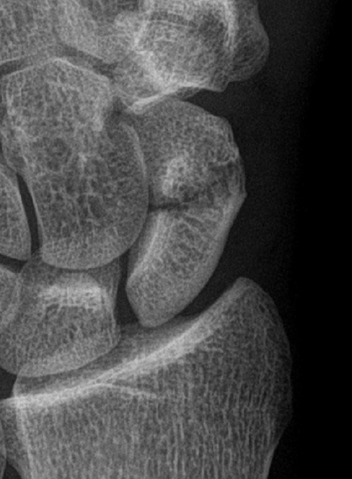 File:Scaphoid fracture (Radiopaedia 85013-100545 Left scaphoid bone ...