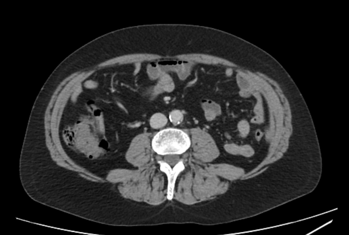 Epiploic Appendagitis Sigmoid Colon Image