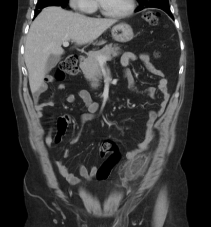 Epiploic appendagitis - sigmoid colon | Radiology Case | Radiopaedia.org