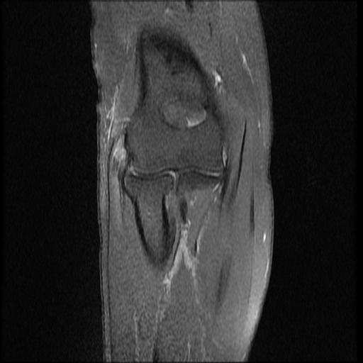 Lateral Epicondylitis Tennis Elbow Image