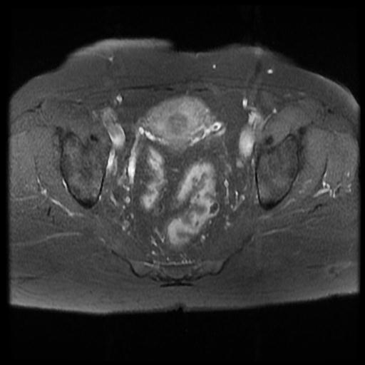 Hydrosalpinx (MRI) | Image | Radiopaedia.org